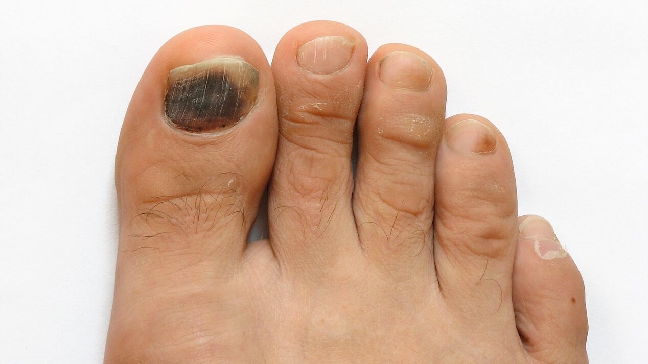symptoms of fungus on the big toe photo 2