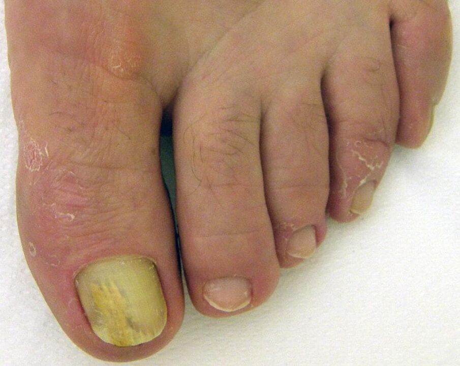 yellow nail with fungus how to treat with drops