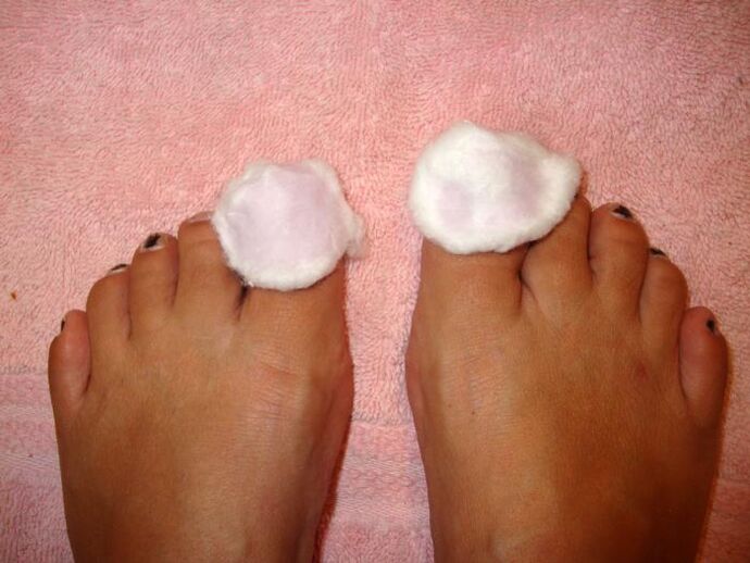 foot fungus lotions