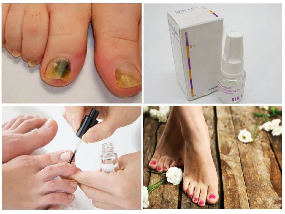 How to use nail polish against nail fungus. 