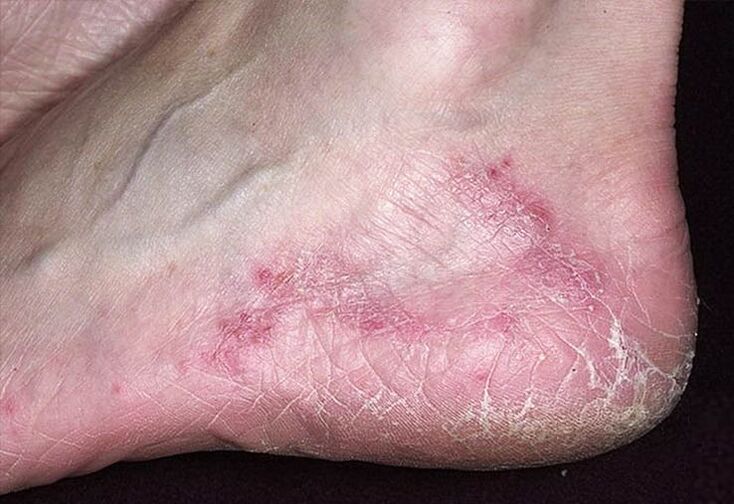 Cracks and redness of the skin on your heels are signs of a fungal infection. 