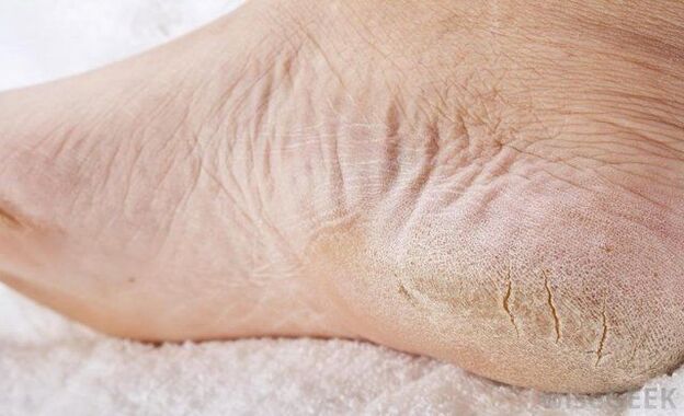 Dry feet are a sign of fungus. 