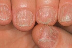The fungus injury