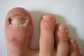 nail fungus