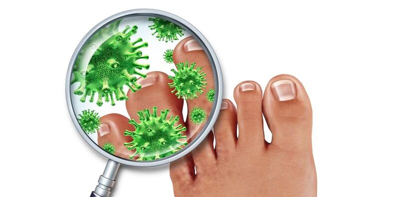 Nails infected with a fungus