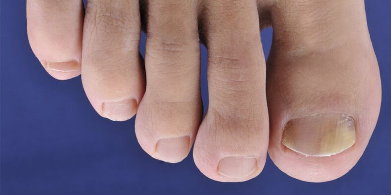 Symptoms of skin mycosis and nail plates