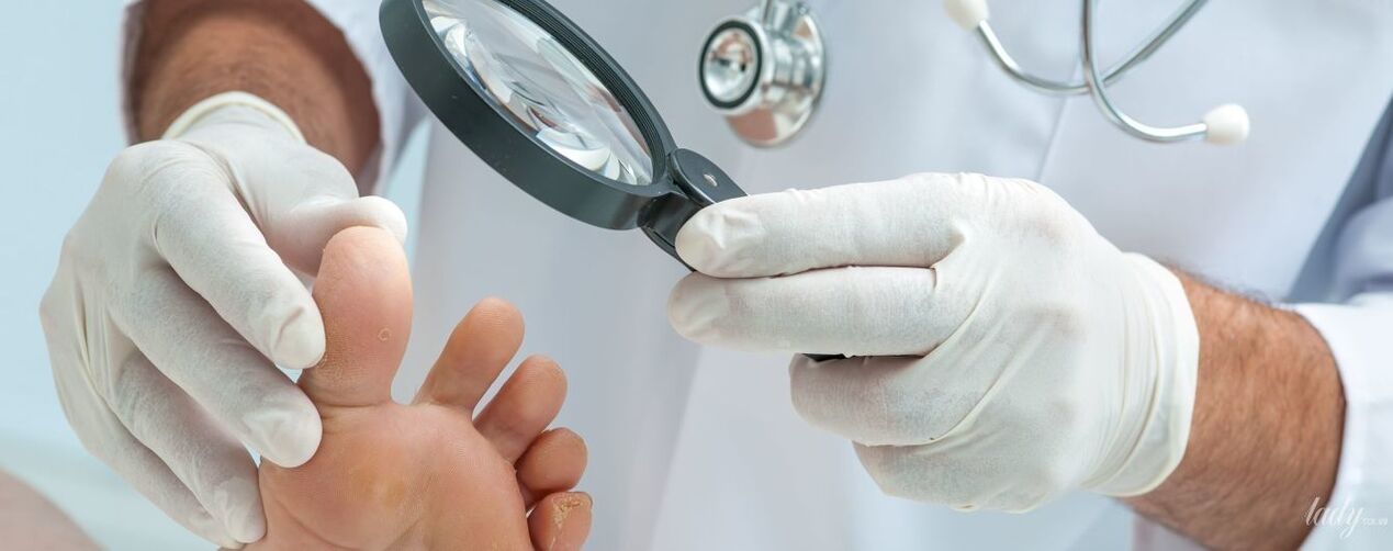 The doctor examines the fungus on the foot of the foot
