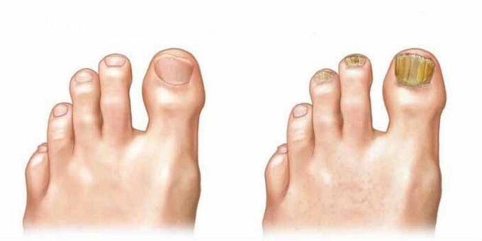 How do you see the fungus on the nails