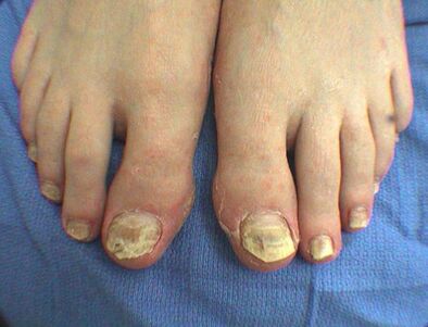 Nail fungus symptoms