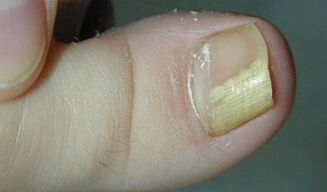 Signs and symptoms of nail fungus