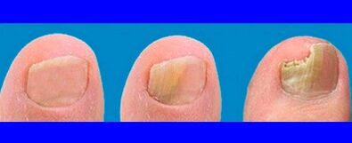 Stages of fungus development on feet fingers