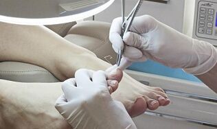Surgical elimination of the nail in the presence of a fungus