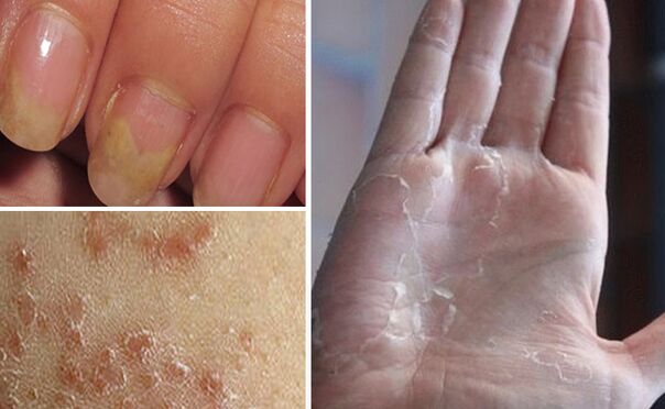 Can mycosis change to other parts of the body