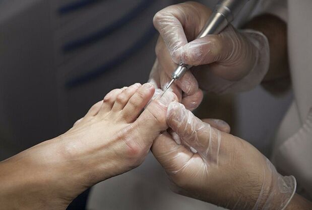 Diagnosis of leg fungus