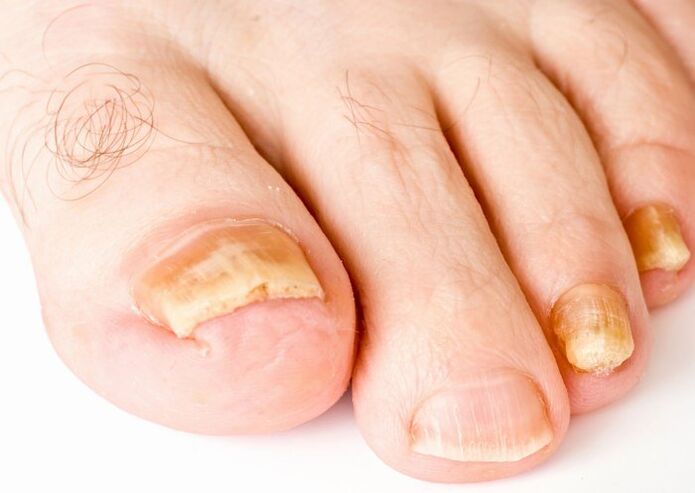 Yellow color of the nail plate due to fungus.