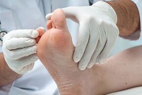The doctor examines the feet for toe fungus.