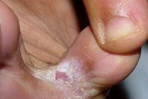 symptoms of fungus between the toes