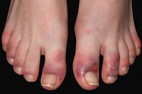 toe fungus symptoms