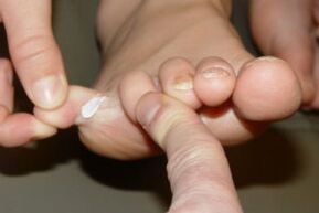 toe fungus