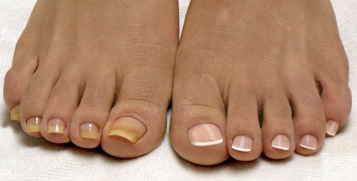 healthy toenails and fingernails affected by fungus