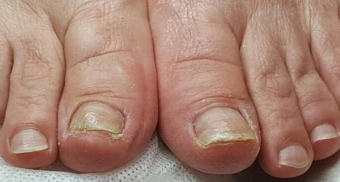 nail damage with toe fungus