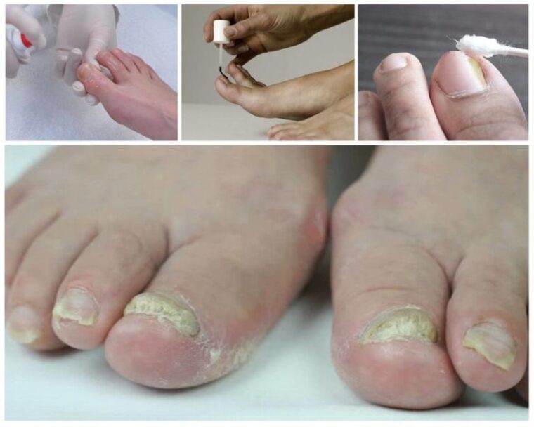 toenail fungus remedies