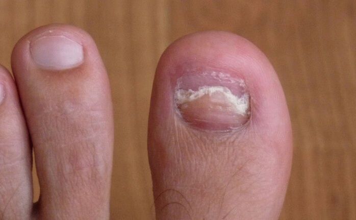 Damage to the nail of the big toe with a fungus. 
