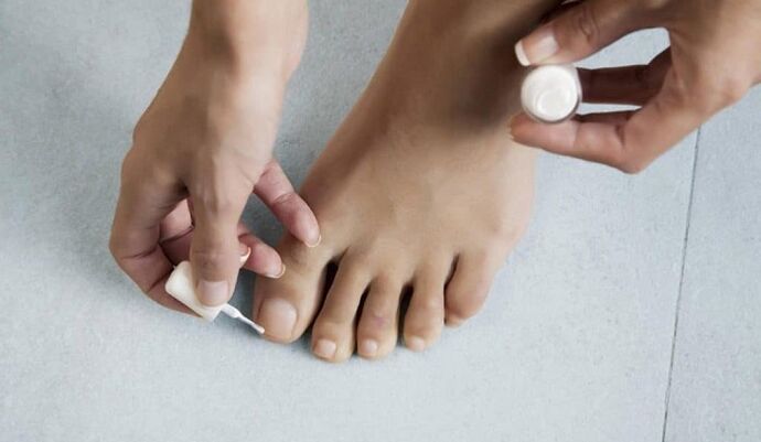 treatment of fungus on the big toe with varnish