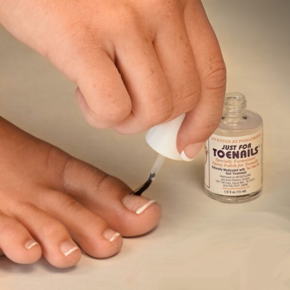 Fungal varnish is used in the early stages of fungal nail infection